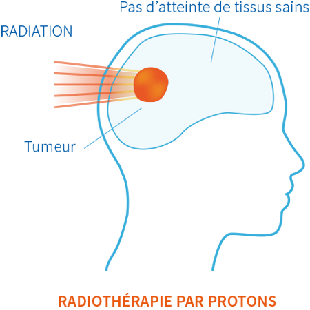 radiotherapie-par-protons-protontherapie-normandie